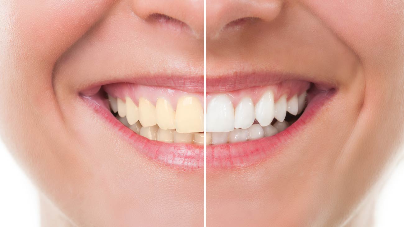 sbiancamento dentale
